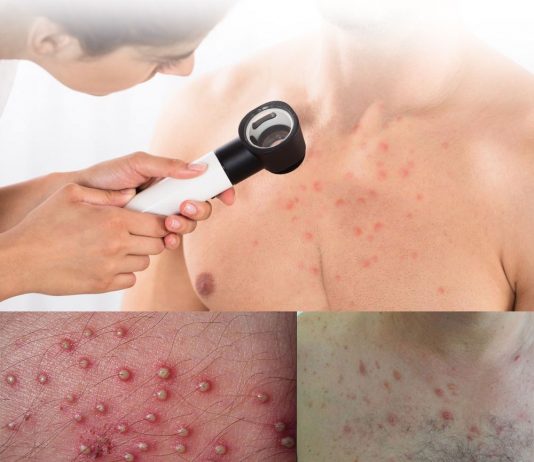 Folikülit Acil Yaklaşım