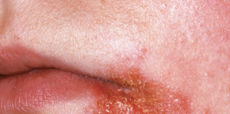 İmpetigo Acil Yaklaşım