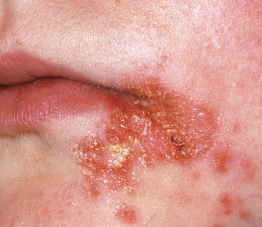 İmpetigo Acil Yaklaşım