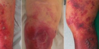 Nekrotizan Fasiit Acil Yaklaşım