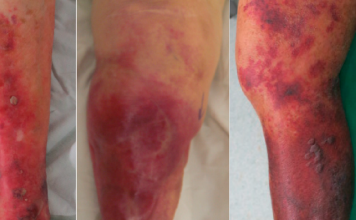 Nekrotizan Fasiit Acil Yaklaşım