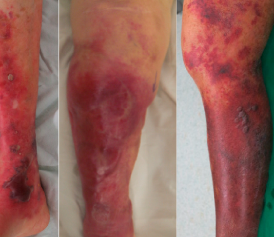 Nekrotizan Fasiit Acil Yaklaşım