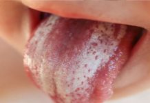 Pamukçuk (Moniliazis)