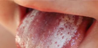 Pamukçuk (Moniliazis)