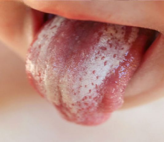 Pamukçuk (Moniliazis)