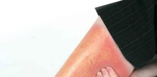 Sellülit Acil Yaklaşım