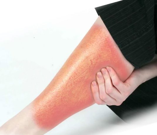 Sellülit Acil Yaklaşım