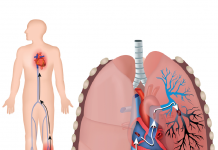 Akut Pulmoner Tromboemboli Acil Yaklaşım