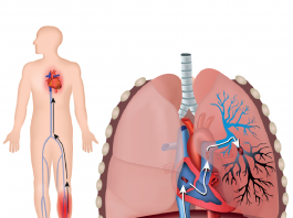 Akut Pulmoner Tromboemboli Acil Yaklaşım