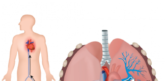 Akut Pulmoner Tromboemboli Acil Yaklaşım