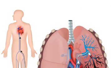 Akut Pulmoner Tromboemboli Acil Yaklaşım