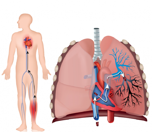 Akut Pulmoner Tromboemboli Acil Yaklaşım