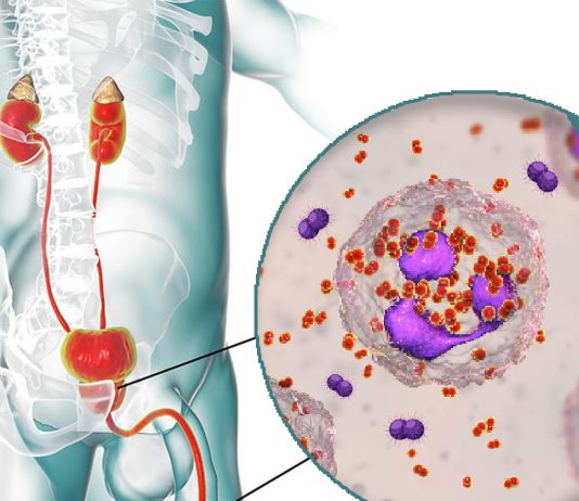 Üretrit Acil Yaklaşım