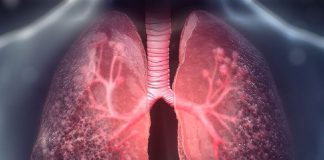 İnterstisyel Akciğer Hastalıkları