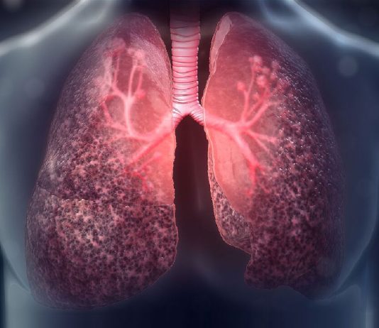 İnterstisyel Akciğer Hastalıkları