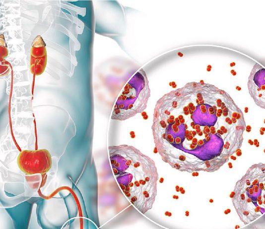 Gonore Hastalığı (Bel Soğukluğu)