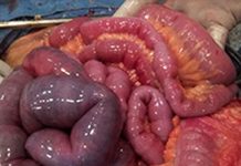 Akut Mezenterik İskemi