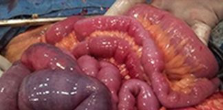 Akut Mezenterik İskemi