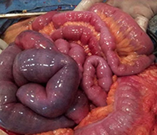 Akut Mezenterik İskemi