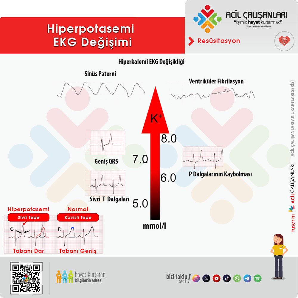 Hiperkalemi EKG