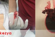 Hematokezya