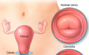 Servisit Acil Yaklaşım