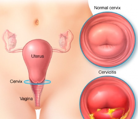 Servisit Acil Yaklaşım