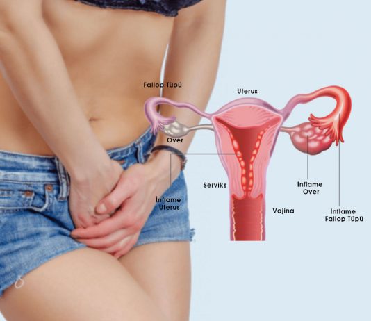 Pelvik İnflamatuvar Hastalık (PID) Acil Yaklaşım