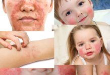 Atopik Dermatit (Egzema) Acil Yaklaşım