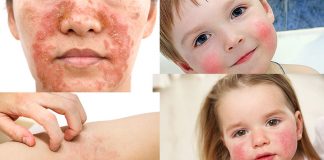 Atopik Dermatit (Egzema) Acil Yaklaşım