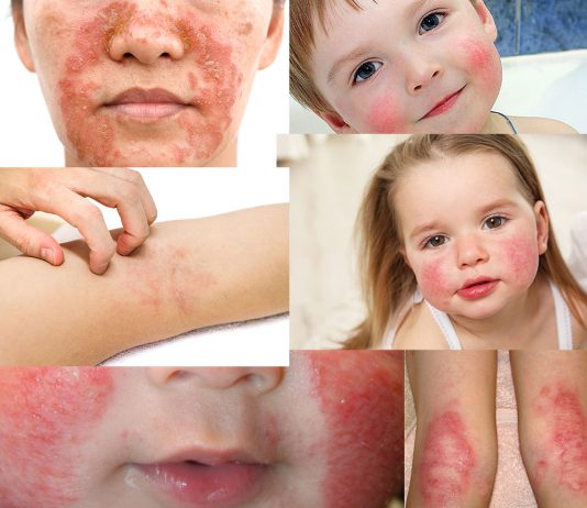 Atopik Dermatit (Egzema) Acil Yaklaşım