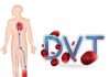 Derin Ven Trombozu (DVT) Acil Yaklaşım