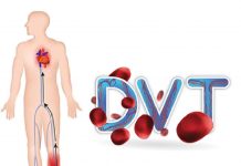 Derin Ven Trombozu (DVT) Acil Yaklaşım