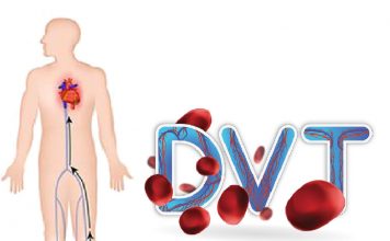 Derin Ven Trombozu (DVT) Acil Yaklaşım