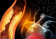 Sağ Ventriküler Miyokard İnfarktüsü (STEMİ)