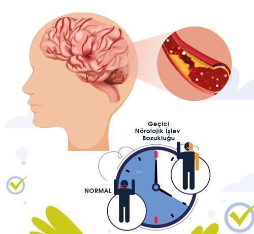 Geçici İskemik Atak (TİA : GİA)