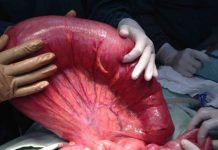 Volvulus Acil Yaklaşım