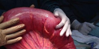 Volvulus Acil Yaklaşım