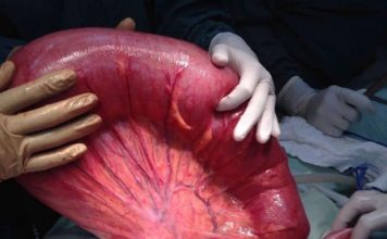 Volvulus Acil Yaklaşım