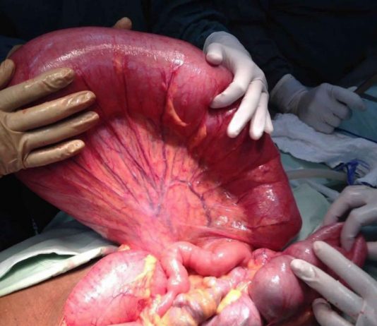 Volvulus Acil Yaklaşım