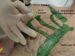 İğne Dekompresyon Uygulaması