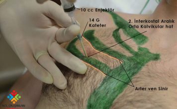 İğne Dekompresyon Uygulaması