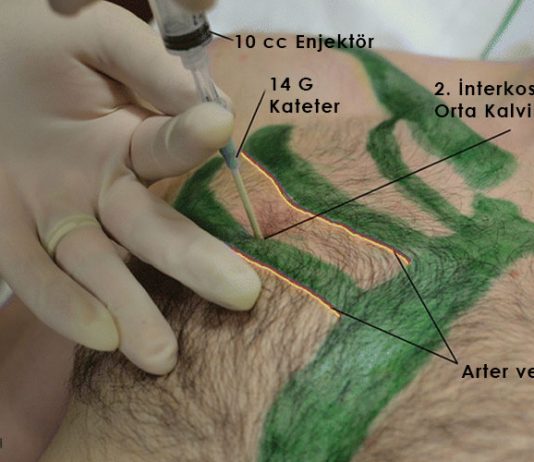 İğne Dekompresyon Uygulaması