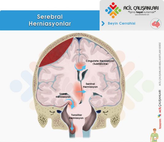 Serebral Herniasyonlar Acil Yaklaşım