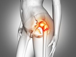 Proksimal Femur Kırıkları Acil Yaklaşım