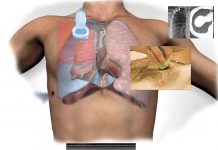 Pnömotoraks’a Yönelik Akciğer Ultrasonu (PoCUS)