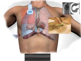 Pnömotoraks’a Yönelik Akciğer Ultrasonu (PoCUS)