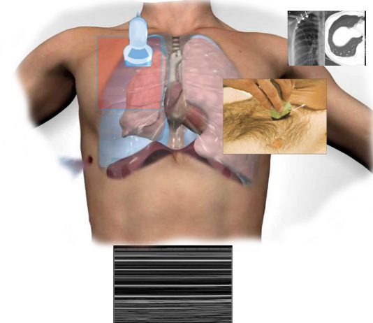 Pnömotoraks’a Yönelik Akciğer Ultrasonu (PoCUS)