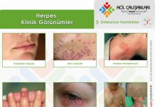Herpes Enfeksiyonları