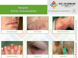 Herpes Enfeksiyonları